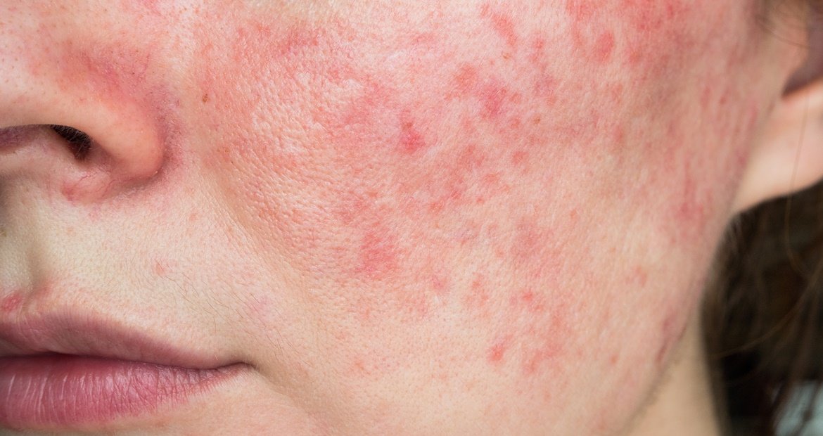 Como surge a rosácea?